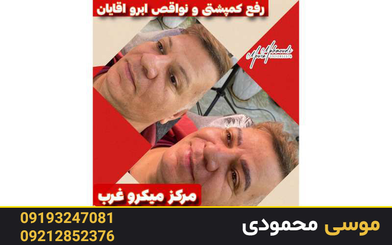 میکروبلیدینگ یا هاشور ابروی مردان